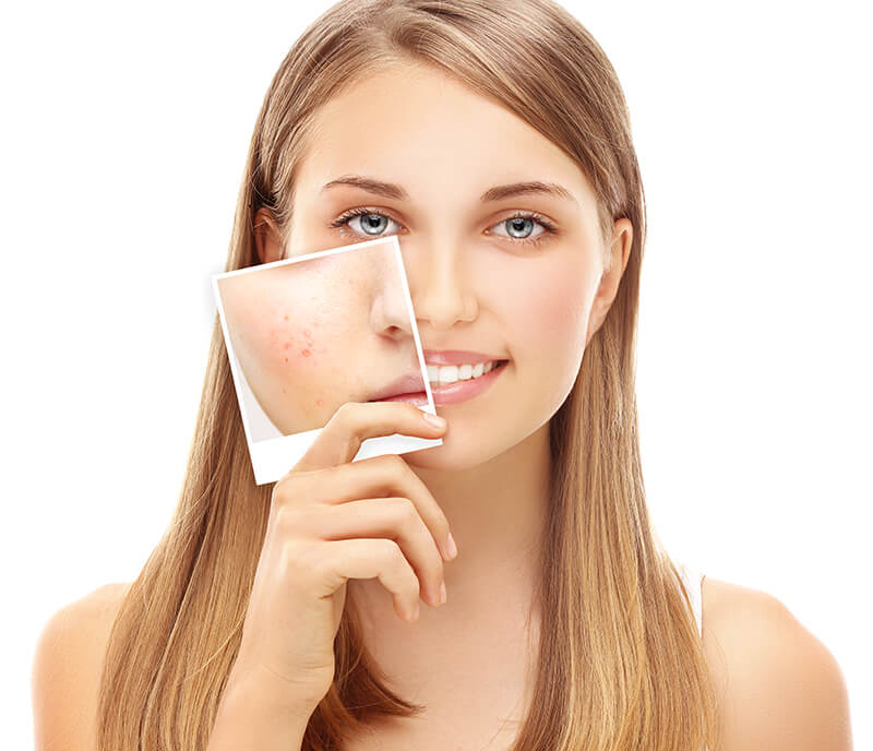 rosacea
