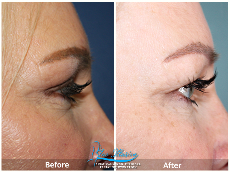 (Blepharoplasty) Eyelid Surgery San Diego