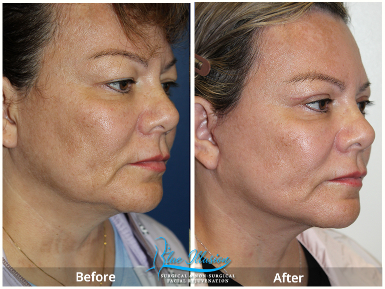Facelift Eyelift Neck Lift San Diego