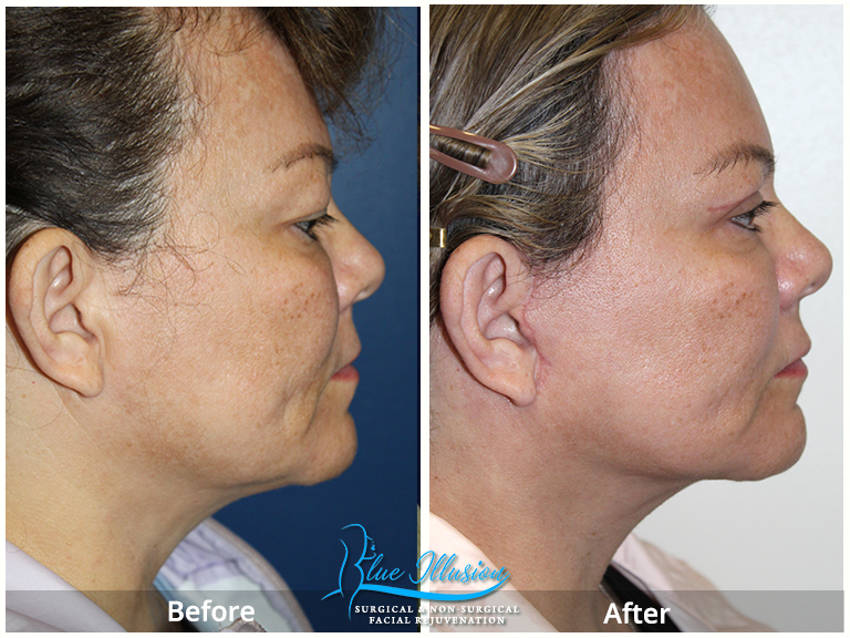 Facelift Eyelift Neck Lift San Diego